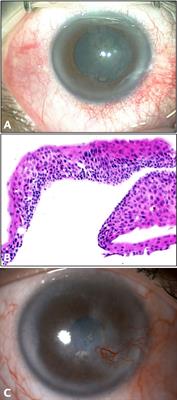 Case report: Clinical features and management outcomes of isolated corneal intraepithelial neoplasia